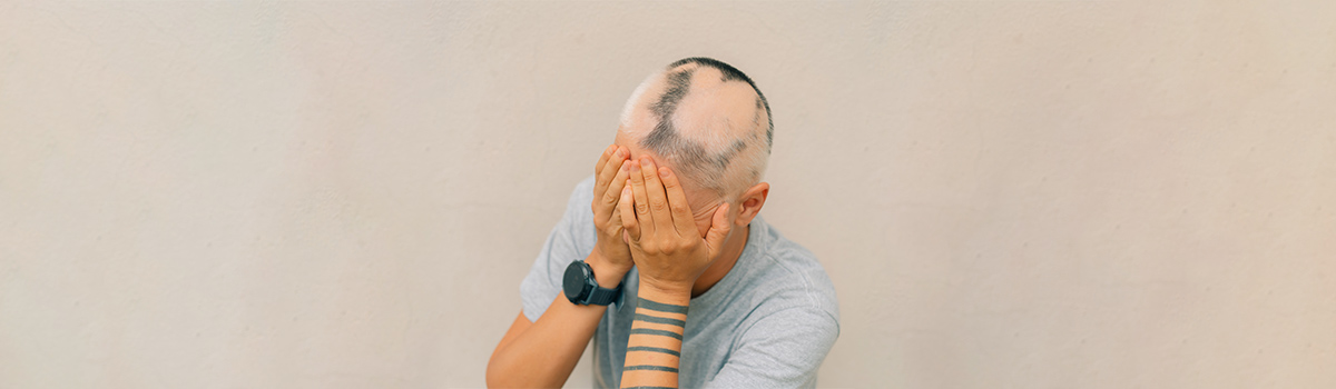 Alopecia Areata
