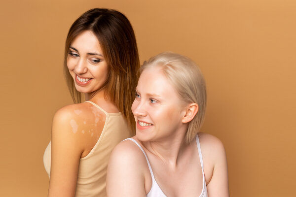 Albinism VS Vitiligo