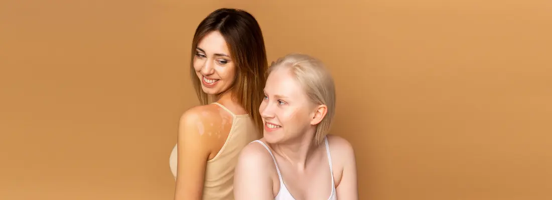 Albinism VS Vitiligo