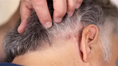 Scalp Eczema vs Psoriasis