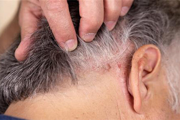 Scalp Eczema VS Psoriasis