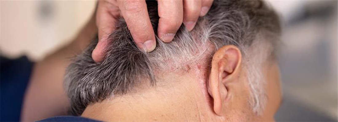 Scalp Eczema VS Psoriasis