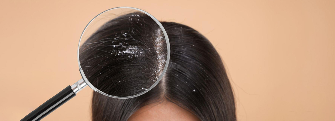 Scalp Psoriasis