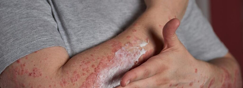 Psoriasis and weight gain