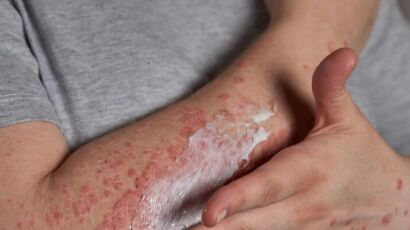 Psoriasis and weight gain