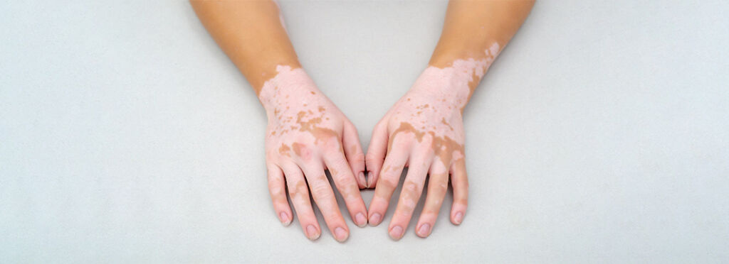 Leucoderma VS Vitiligo