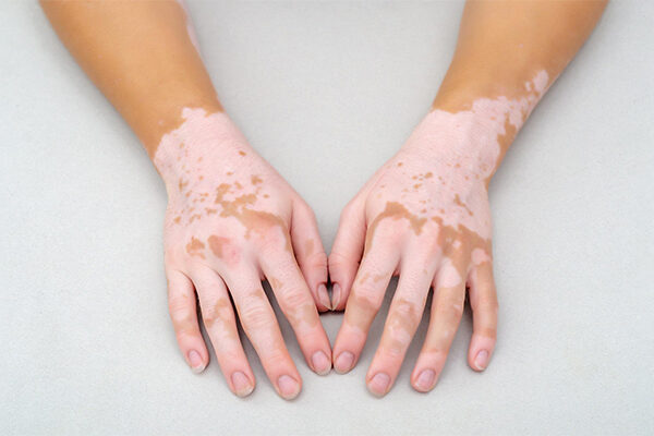 Leucoderma vs Vitiligo