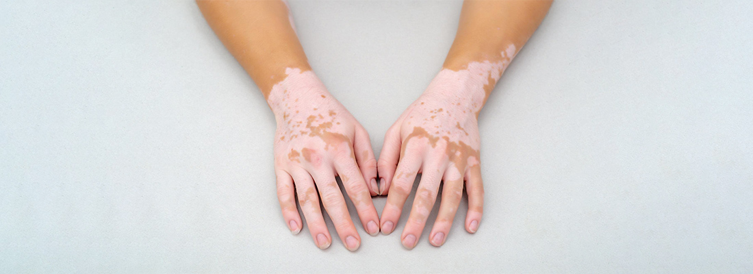 Leucoderma vs Vitiligo