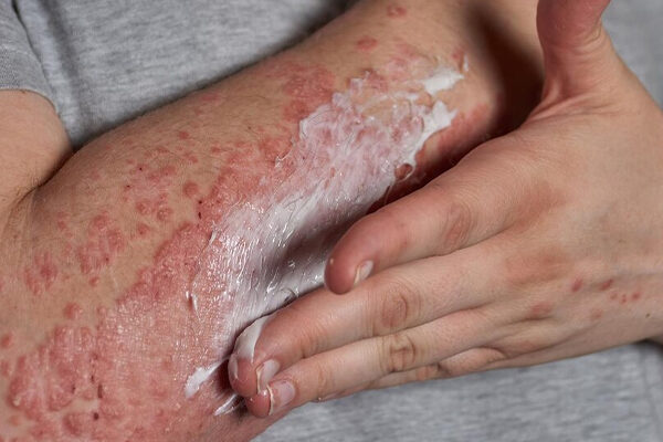 Psoriasis and Weight Gain