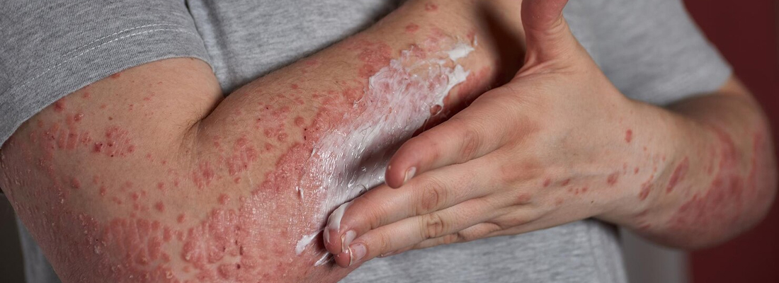 Psoriasis and Weight Gain