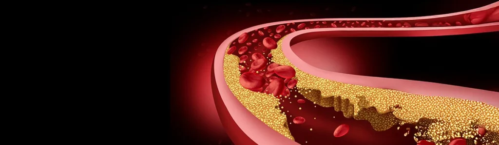 Elevated Lipoprotein a Clinical Trials