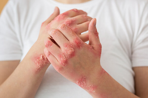 Plaque Psoriasis Symptoms
