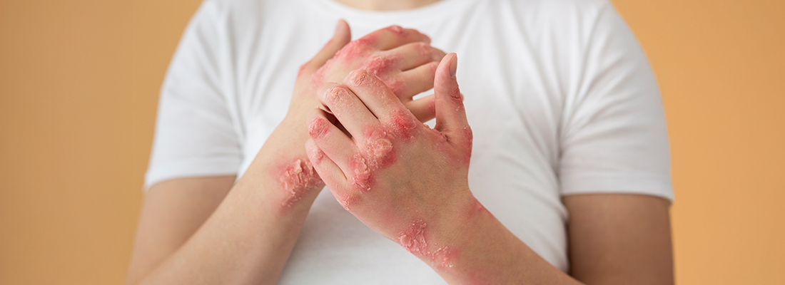 Plaque Psoriasis Symptoms