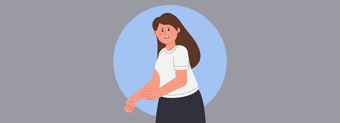 Plaque Psoriasis vs Eczema