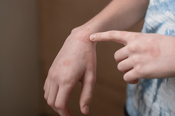 Spongiotic Dermatitis with Eosinophils