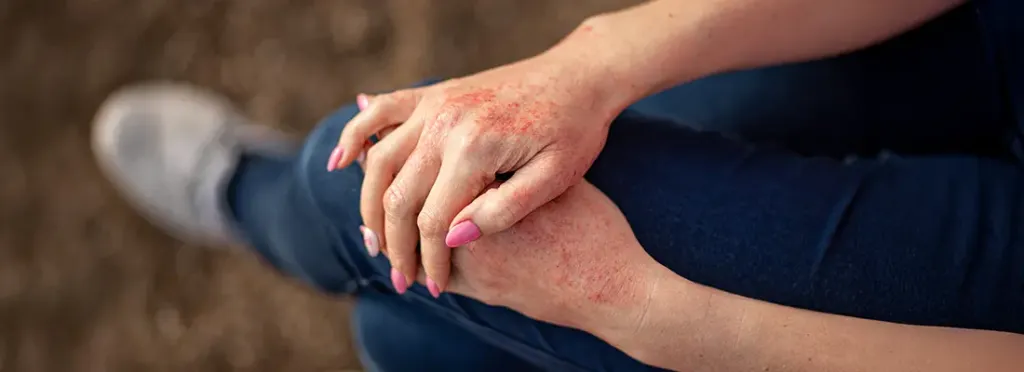 Eczema Symptoms