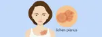 Lichen Planus Pigmentosus: Causes, Treatment Options, and More