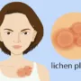 Lichen Planus Pigmentosus: Causes, Treatment Options, and More