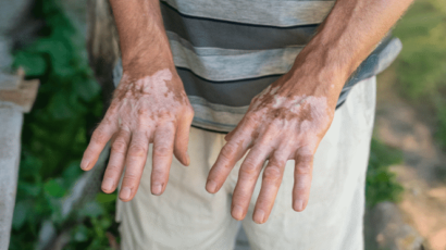 Penile Vitiligo