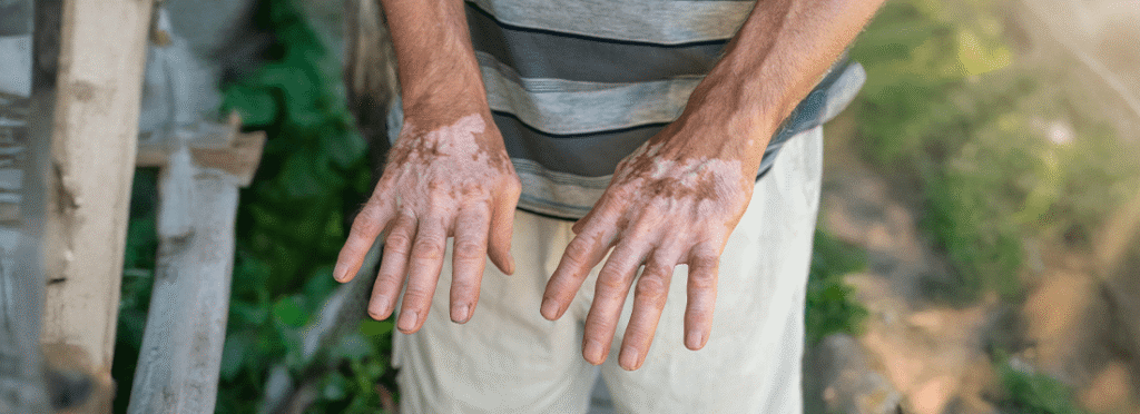 Penile Vitiligo