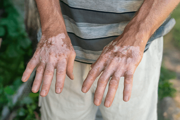 Penile Vitiligo