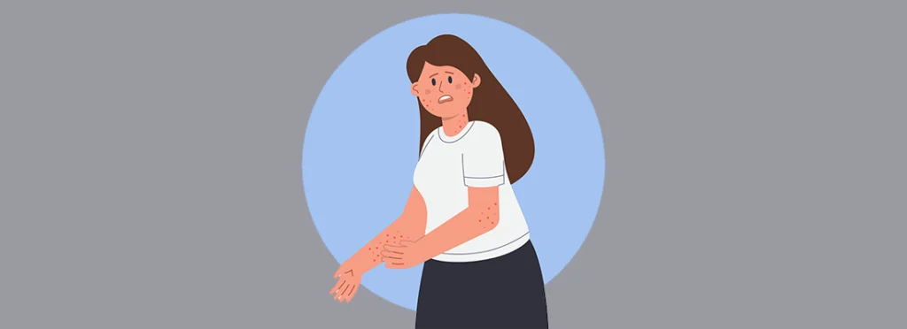 Plaque Psoriasis vs Eczema