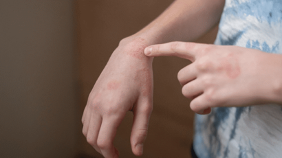 Spongiotic Dermatitis with Eosinophils