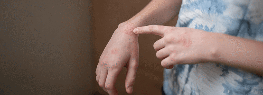 Spongiotic Dermatitis with Eosinophils