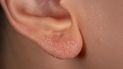 Eczema in Ears