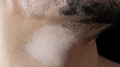 Hypopigmentation