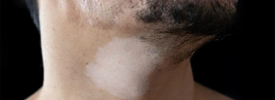 Hypopigmentation