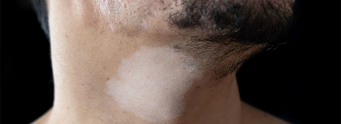 Hypopigmentation