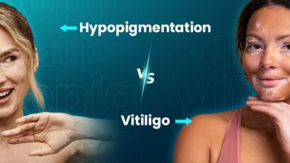 Hypopigmentation vs Vitiligo