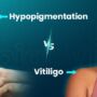 Hypopigmentation vs Vitiligo: Understanding the Key Differences and Causes