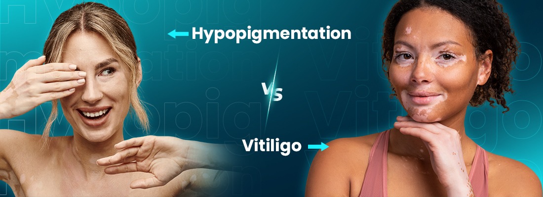 Hypopigmentation vs Vitiligo