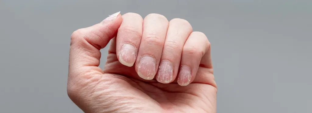 Alopecia Areata Nails