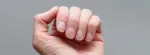 How Alopecia Areata Affects Your Nails: Signs, Diagnosis, and Treatment
