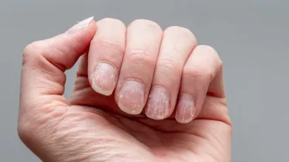 Alopecia Areata Nails