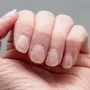How Alopecia Areata Affects Your Nails: Signs, Diagnosis, and Treatment