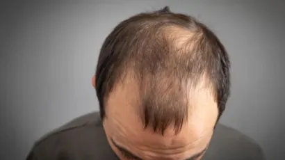 How to Stop Alopecia Areata from Spreading