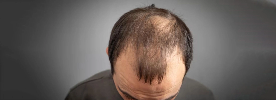 How to Stop Alopecia Areata from Spreading