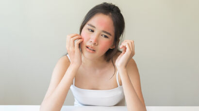 Is Rosacea Itchy