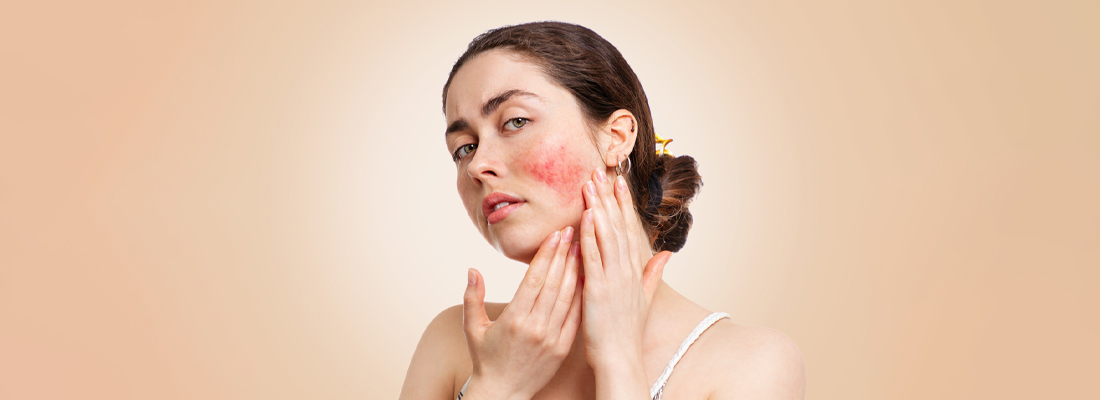 Types of Rosacea