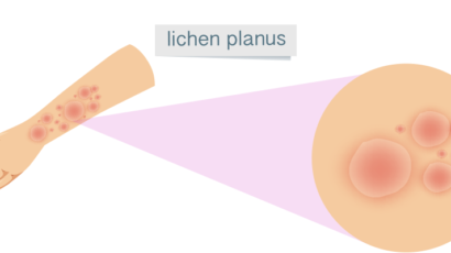 Lichen Planus VS Lichen Sclerosus