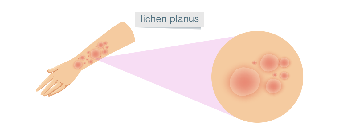 Lichen Planus VS Lichen Sclerosus