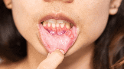 Oral Lichen Planus Vs Leukoplakia