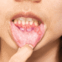 Oral Lichen Planus vs Leukoplakia: Signs and Key Differences