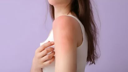 Early Stage Anxiety Stress Hives