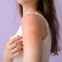 The Hidden Language of Your Skin When Stress Speaks in Hives