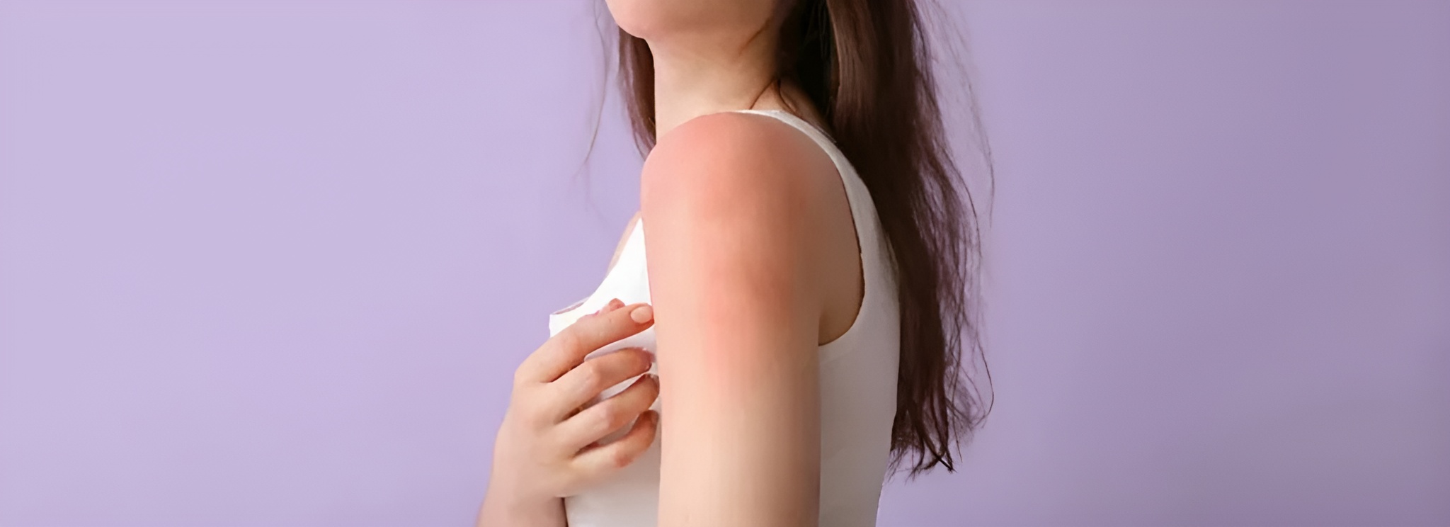 Early Stage Anxiety Stress Hives